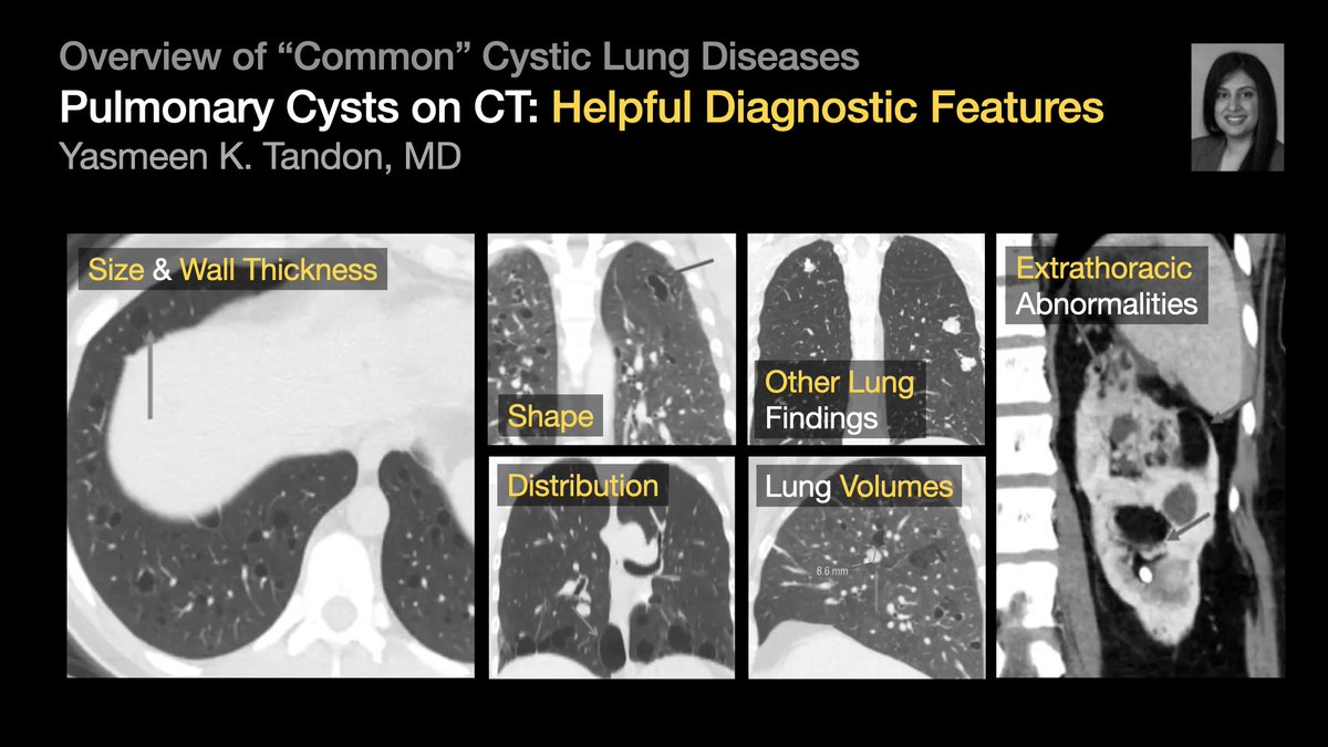 Overview of “Common” Cystic Lung Diseases [1/5] …from Dr. Yasmeen Tandon’s talk at #STR2021 & condensed by @hannadallapria. #radres #Radtwitter #MedTwitter #FOAMrad #FOAMmed