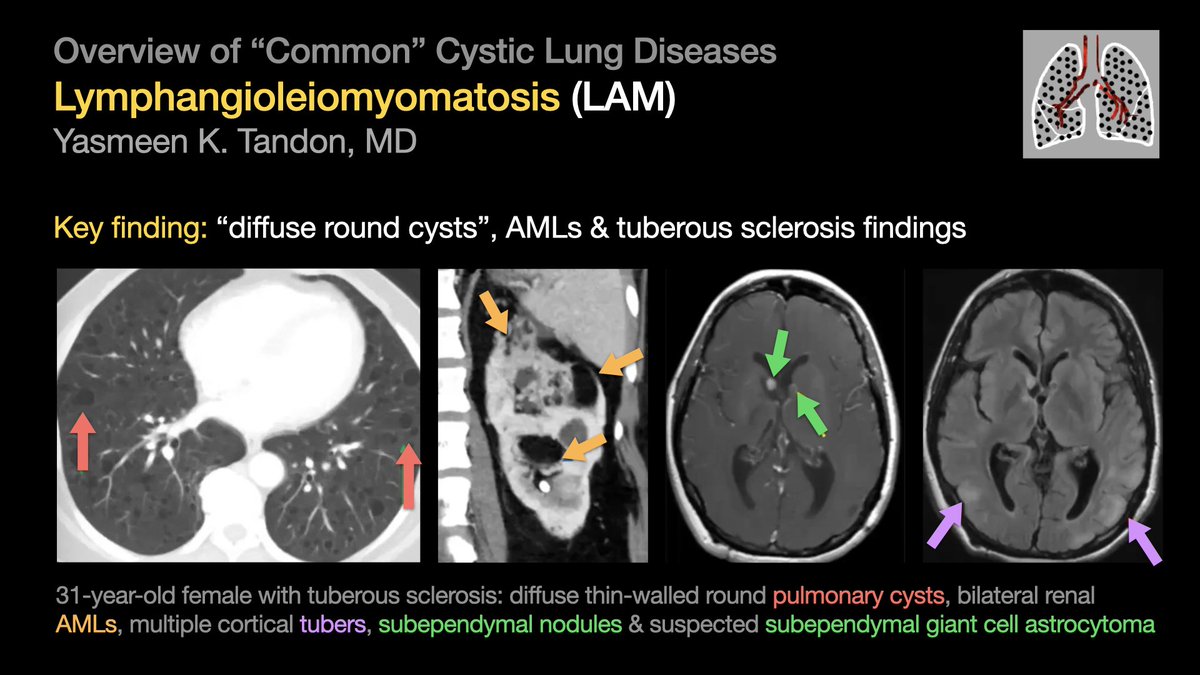 Overview of “Common” Cystic Lung Diseases: Pulmonary Langerhans Cell Histiocytosis (PLCH) & Lymphangioleiomyomatosis (LAM) [2/5] …from Dr. Yasmeen Tandon’s talk at #STR2021 & condensed by @hannadallapria. #radres #Radtwitter #MedTwitter #FOAMrad #FOAMmed