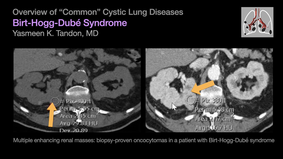 Overview of “Common” Cystic Lung Diseases: Birt-Hogg-Dubé syndrome [4/5] …from Dr. Yasmeen Tandon’s talk at #STR2021 & condensed by @hannadallapria. #radres #Radtwitter #MedTwitter #FOAMrad #FOAMmed