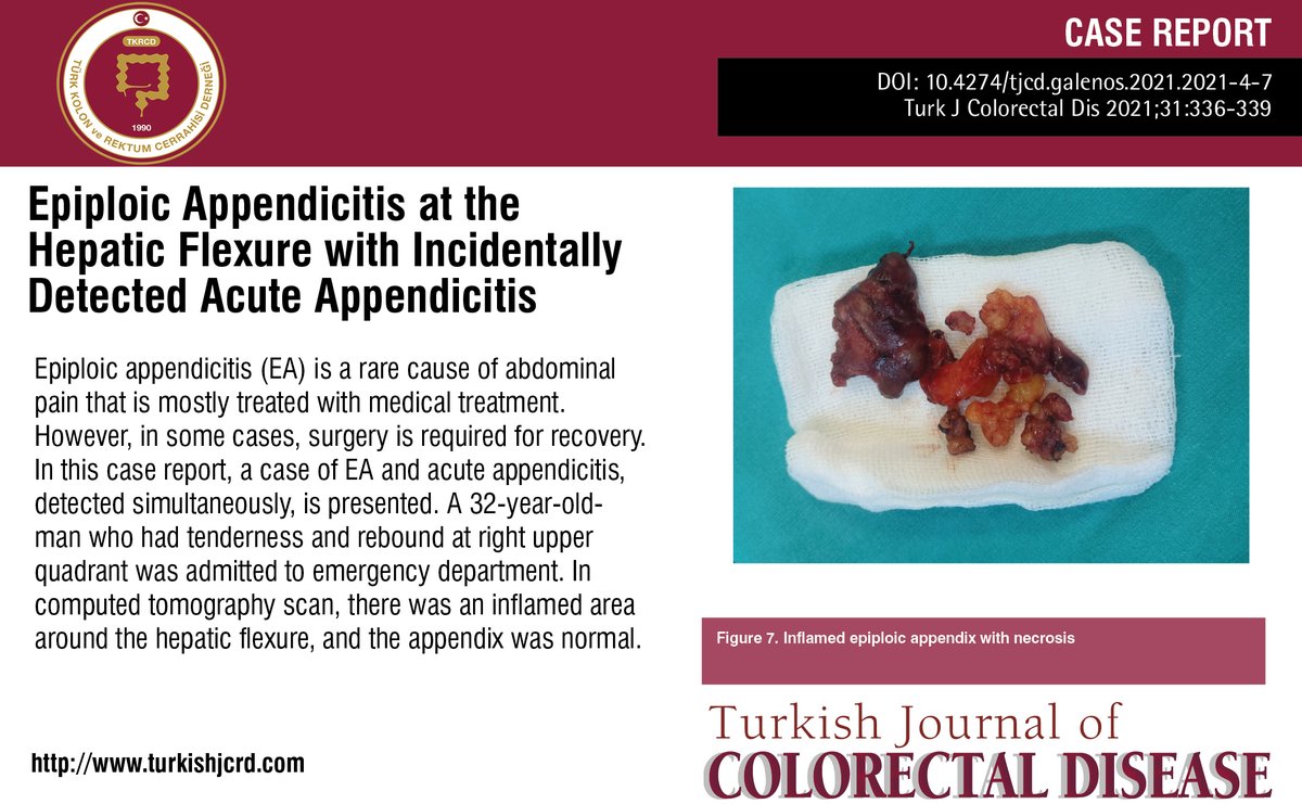 turkdiscolrect's tweet image. Epiploic Appendicitis at the Hepatic Flexure with Incidentally Detected Acute Appendicitis

You can see the free full text of the research by Tolga Kalaycı.

Link : cms.turkishjcrd.com/Uploads/Articl…

#Appendicitis #diagnosticlaparoscopy #epiploicappendicitis #medicaltreatment