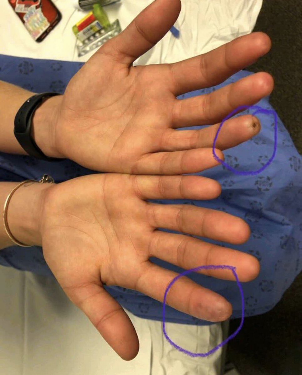 🔍 Investigating digital abnormalities! 

🖐️ History of #puffy_fingers and #ulcers. 

What's the likely #diagnosis?

A. Scleroderma
B. Raynaud's phenomenon
C. Gangrene

#Rheumatology #VascularHealth #MCQ 🩺