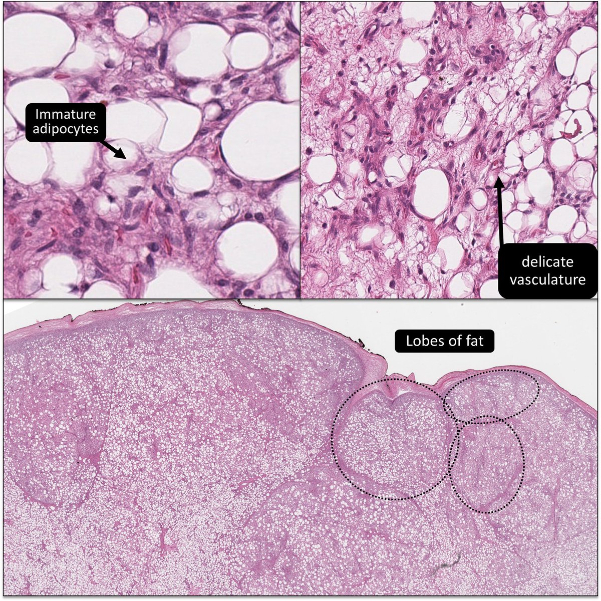 DrCycloPath's tweet photo. 2⃣🎂👶♂️ Diagnosis?
A) Myxoid liposarcoma
B) Lipoblastoma-like tumor
C) Lipoblastoma
#PathResidents #PediPath #BSTPath #DermPath #PathTwitter
🔬https://t.co/31UJR0ZUFV https://t.co/3jJqf1EdY4