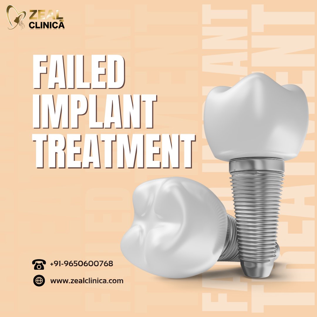 Turning setbacks into success stories! 💥 Join us as we navigate the highs and lows of failed implant #Treatment, offering insights, support, and tips for overcoming challenges on the road to #Dental restoration. 💪 . . #failedimplant #implant #implanttreatment #dentalimplants