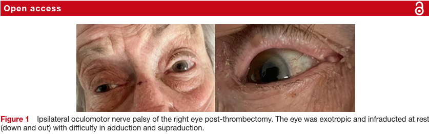 JNNP_BMJ's tweet photo. 🔊 Oculomotor palsy and drowsiness due to post-thrombectomy subarachnoid haemorrhage falsely suggesting transtentorial herniation

Read the paper:
https://t.co/VOg687A99R https://t.co/88mhkSrwNL