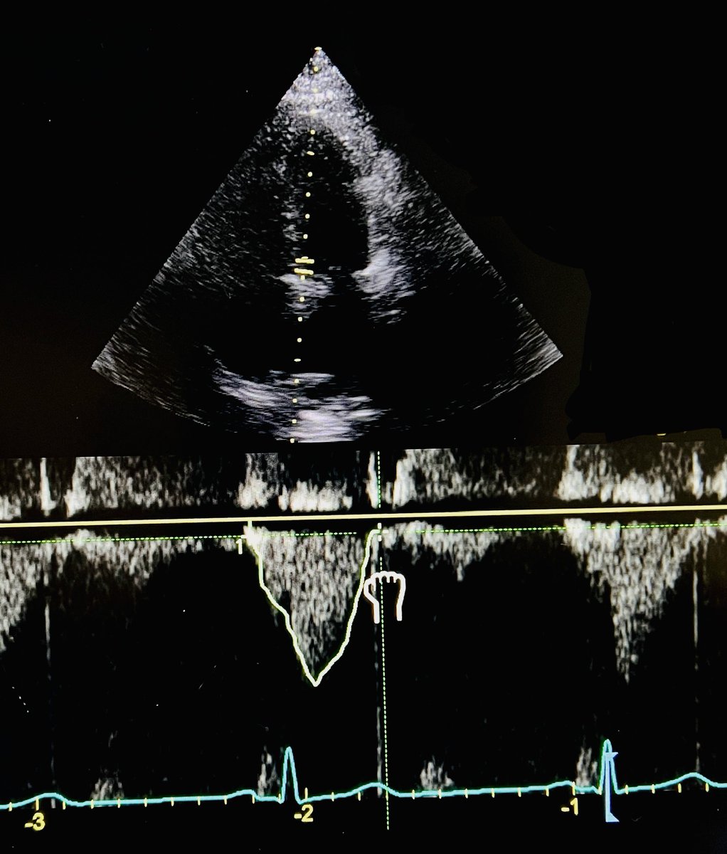 saikatmitra05's tweet photo. #POCUS #Haemodynamics #MedTwitter #FOAMed 

VExUS likely predicts imminent fluid congestion even before clinically evident !!👇

> A patient with aspiration pneumonia and septic shock (D2 in ICU) —> still on nor adr 6-8 mcg/min. 
> EF 60%, mild TR
> Fluid balance: + 1.5lit
> Oxygen requirement stable ~ 35-40%
> No pedal or sacral oedema

Repeat POCUS: VTI 28cm 😳 
—> Likely high output state from sepsis

More deets to be followed below 👇