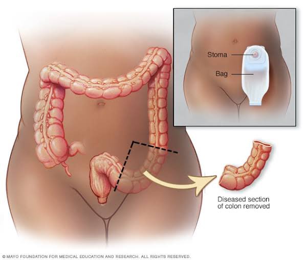 DrMedica_13's tweet image. 🔍 Exploring gastrointestinal resections! 

🩺 Which of the following results in #macrocytosis post-resection, #except?

A. Ileum
B. Jejunum
C. Stomach
D. Duodenum

#Gastroenterology #MCQ 🍽️