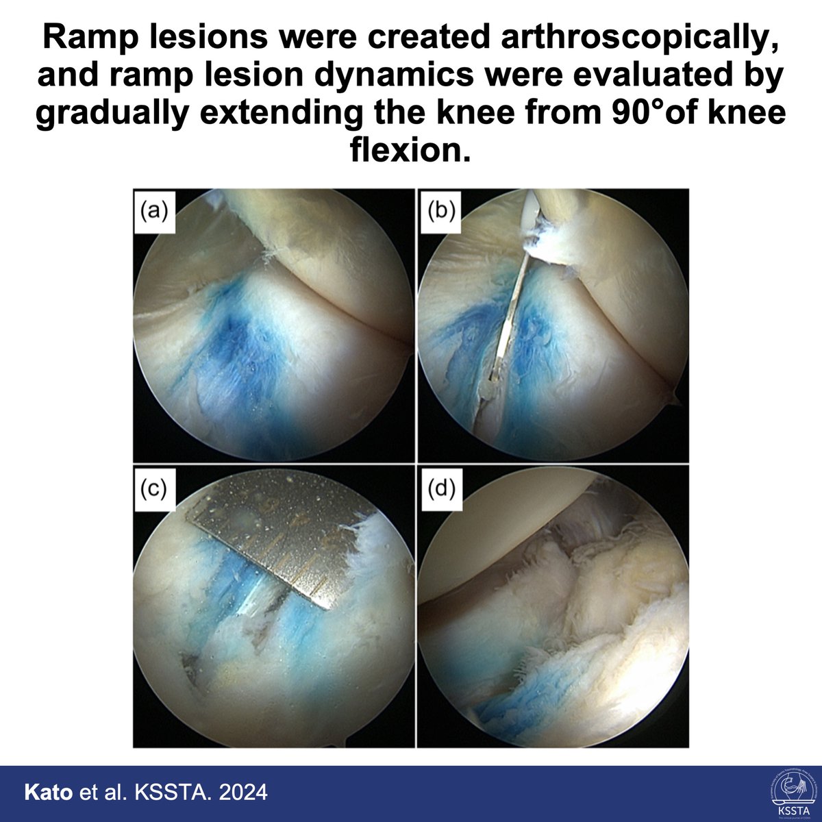 KSSTA's tweet photo. This cadaveric study investigated the behaviour of ramp lesions and their repair in different flexion angles.
#knee #meniscus #ramplesions #repair #allinside #biomechanics
Read here: https://t.co/LiGpoekhEx https://t.co/rSQzH3iCxe
