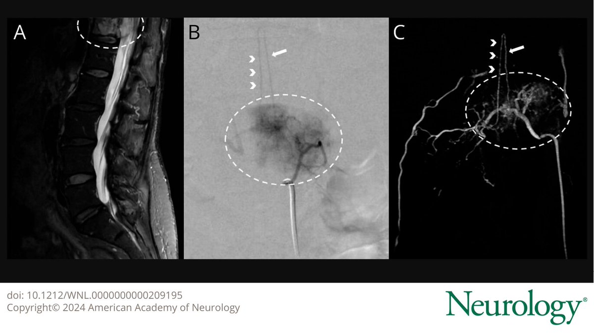 GreenJournal's tweet photo. Identifying the artery of Adamkiewicz is crucial in tumor embolization because its embolization could result in anterior cord ischemia and paraplegia. Learn more in this Teaching #NeuroImage article: https://t.co/aMVIM0Mczu #NeurologyRF https://t.co/wmUYPqvktL