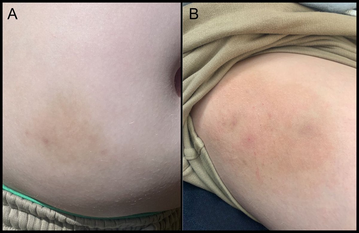 Images in paediatrics

Hyperpigmentation at diabetes technology sites may be indicative of evolving Addison’s disease

(Parental consent obtained)
adc.bmj.com/content/early/…
