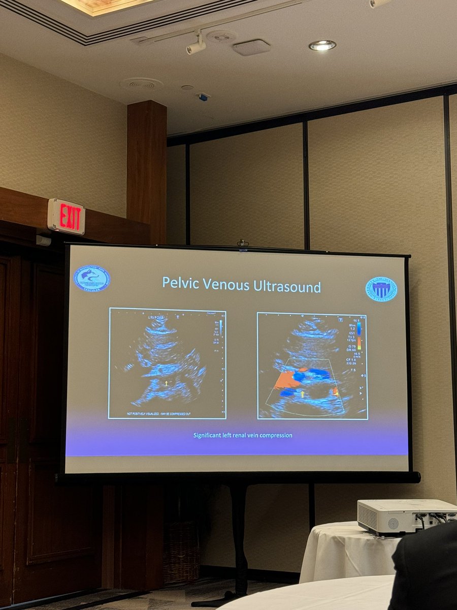 UW Integrated Resident Nico Stafforini @NicoStafforini presenting on left ovarian vein to external iliac vein transposition for treatment of symptomatic, compensated left renal vein compression with left ovarian vein reflux and pelvic pain.