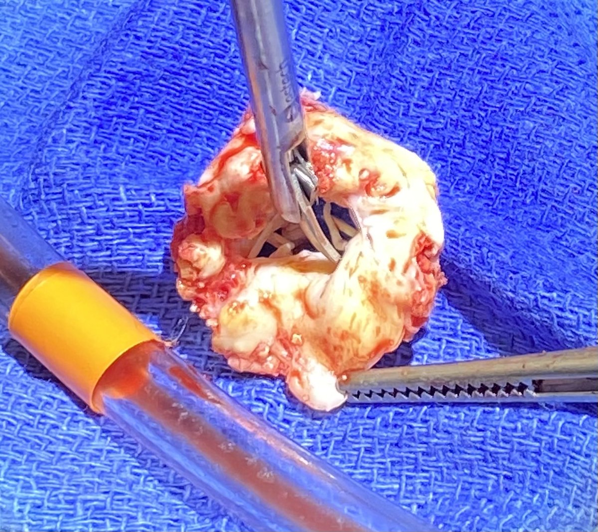 Some patients still live with such stenotic mitral valve which has less opening than 1/4 inch tubing(picture on the right). CUSA is a life saver to clean the MAC for proper suture placement for valve replacement. #cusa #mitral stenosis