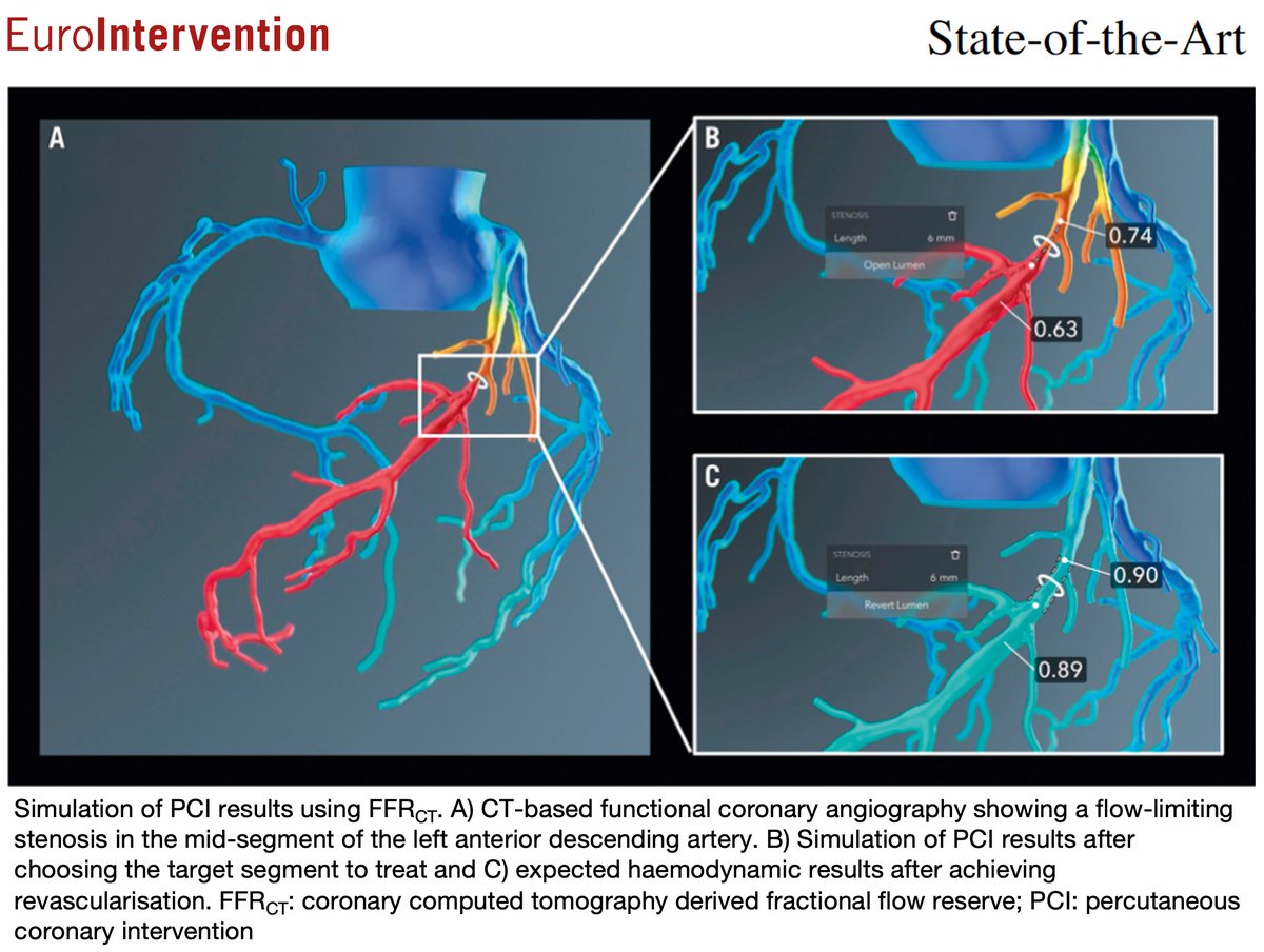 This review aims to summarize the progress in functional coronary angiography, highlight its clinical benefits for patient management, and underscore the potential for further developments in this rapidly evolving area of cardiology. ow.ly/MSUR50QAebV