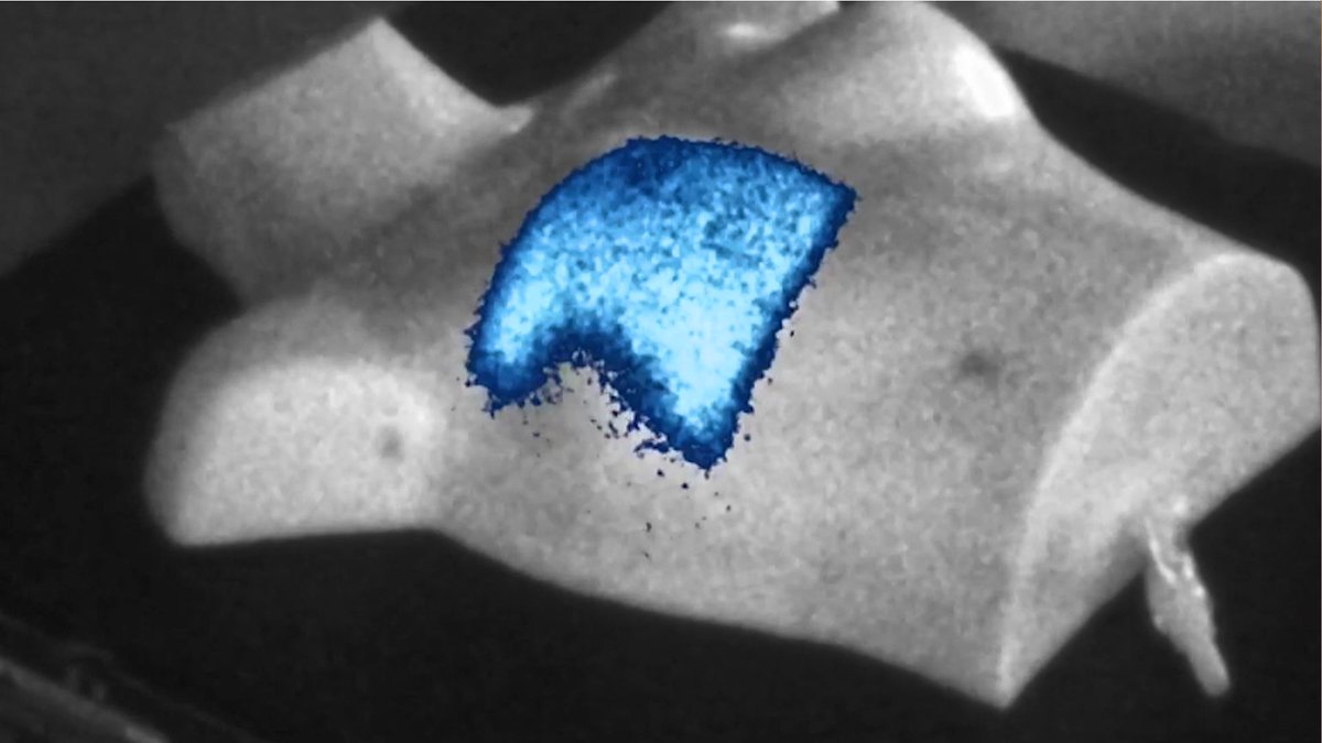 DartmouthRadOnc's tweet image. Our commitment to innovation and pushing the limits of what is possible has led to the discovery and development of Cherenkov emission imaging at #dartmouthradonc. Check out the video on our Instagram to explore the impact of our work. #cherenkov #clinicalresearch