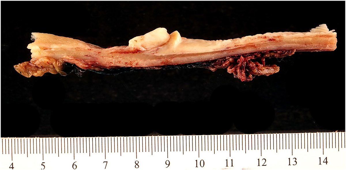 ModernPathology's tweet photo. "We report our experience with 18 cases of primary #SynovialSarcoma (SS) of the (#GastrointestinalTract) & highlight the #clinical, #morphologic, #immunohistochemical, & #molecular features of this tumor to allow its recognition and prevent misdiagnosis."
https://t.co/aGMVVoFOaP https://t.co/9VYDsJ2tCh