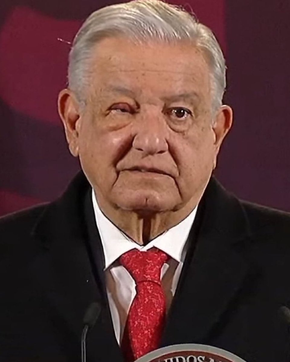 CirujanoGZ's tweet image. El Presidente de #México 🇲🇽, dijo padecer 1 “tutupiche”, tmb conocido como #orzuelo en el 👁 derecho, una infección bacteriana q afecta 1 o + de las pequeñas glándulas cercanas a la base de las pestañas, las glándulas de Zeiss o de Moll. Especialista correspondiente: #Oftalmólogo