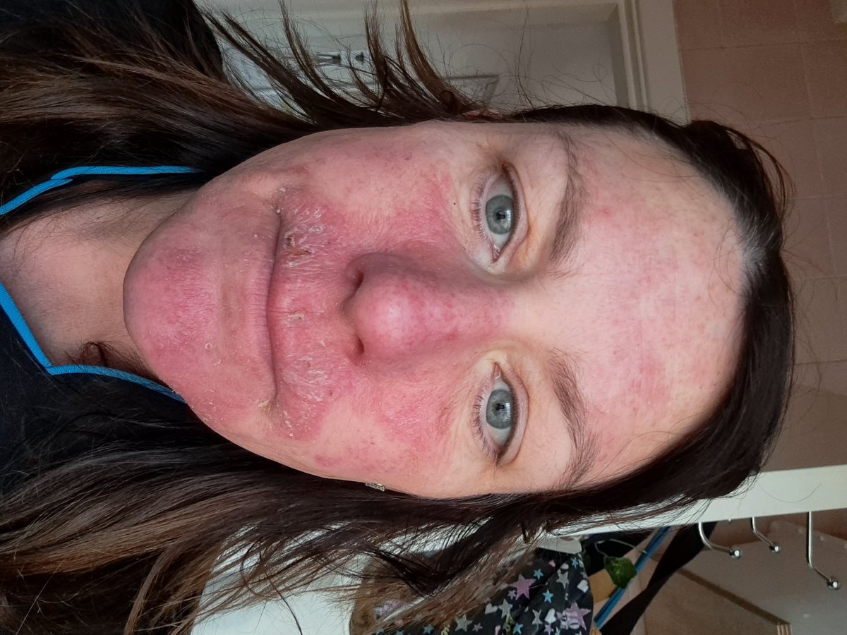 llloydman's tweet photo. I used this face mask and look how it burnt my skin https://t.co/7iWwmwWztP