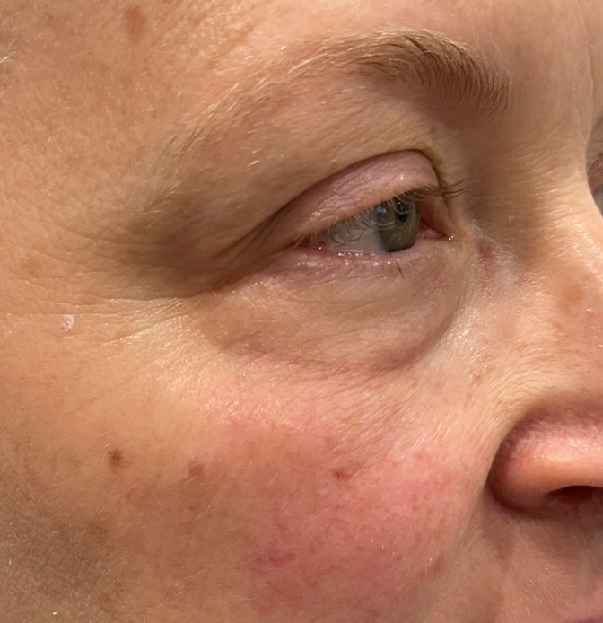 CastleHillsEC's tweet photo. Redness, Dry Eyes, Irritation and Rosacea GONE! 
This patient looks and feels great after her treatments!😁😁😁
Call, Text, or Visit Our Website to Schedule Your Free Consultation Today!!!
https://t.co/zq0xLtEzWk
#dryeyes #rosacea #eyecare #envision #carrolltontx https://t.co/YG0ZHtrLi8