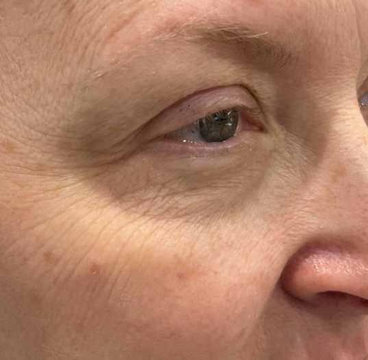 CastleHillsEC's tweet photo. Redness, Dry Eyes, Irritation and Rosacea GONE! 
This patient looks and feels great after her treatments!😁😁😁
Call, Text, or Visit Our Website to Schedule Your Free Consultation Today!!!
https://t.co/zq0xLtEzWk
#dryeyes #rosacea #eyecare #envision #carrolltontx https://t.co/YG0ZHtrLi8