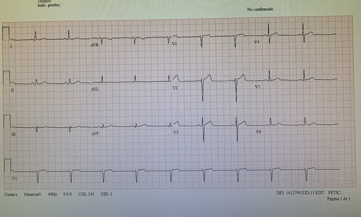 50 y/o 👱🏽‍♂️ No known cardiovascular risk factors. Admitted to ER for CP. #ECG was done. Subtle anterior STEMI or normal variant STE? Comments welcome #CardioTwitter #Cardiology
