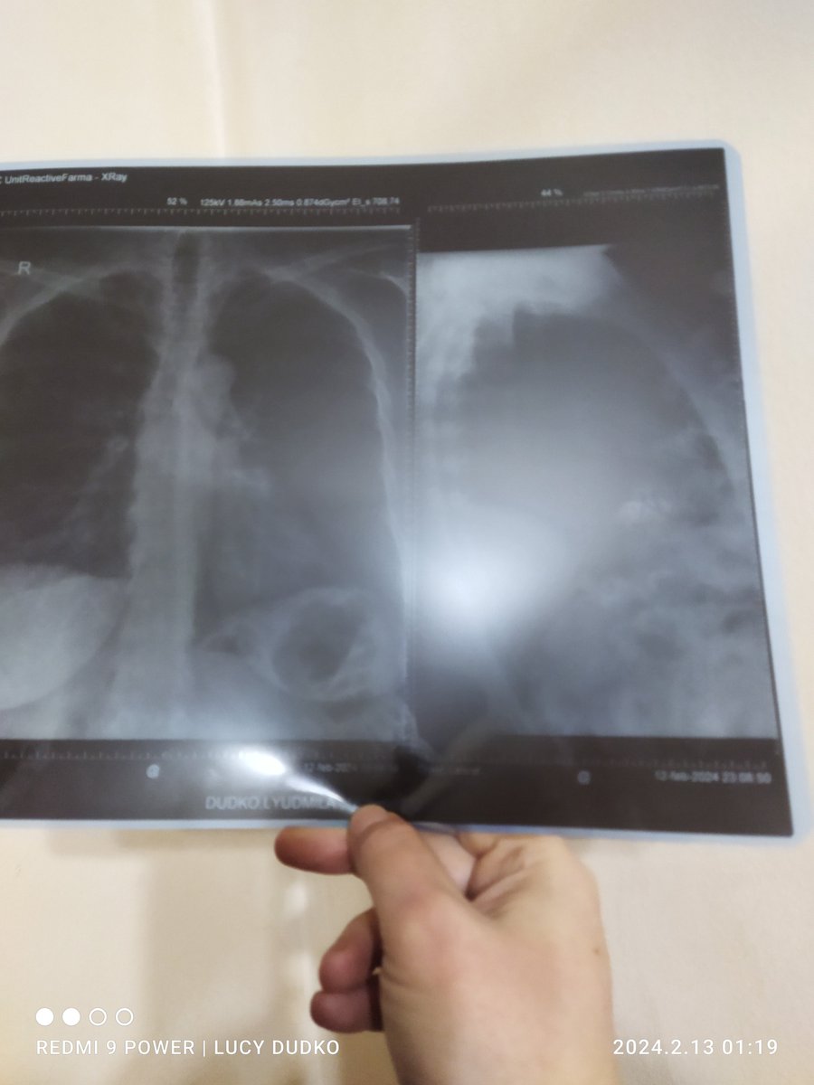 lucy_dudko's tweet image. Our beloved supermodel Lucy Dudko is facing a serious health challenge. Her condition requires maximum support. Let's come together and send her lots of love, prayers, and wishes for a speedy recovery! 💖 #SupportLucy #WeAreWithYouLucy"