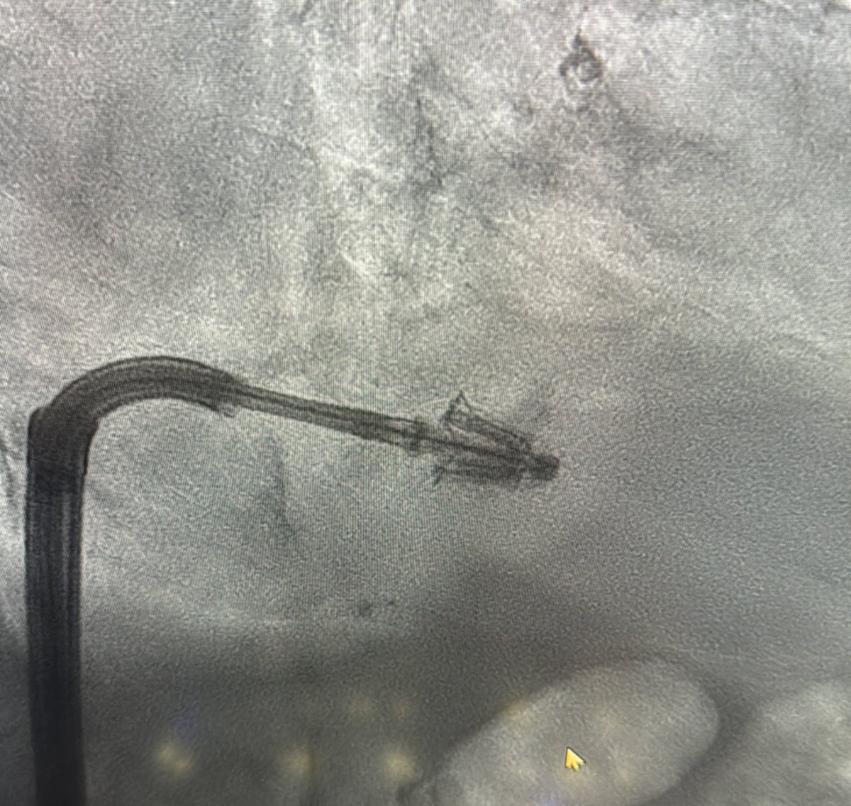 UT Health San Antonio Valve Center (@uthealthsavalve) on Twitter photo Our team continues to be on the front line of bringing new innovations in valvular heart disease to South Texas <a href="/SouthTexasMed/">South Texas Medical Center</a> <a href="/UnivHealthSA/">University Health</a> <a href="/UTHealthcareSA/">UT Health Physicians</a>. Our experts completed South Texas first Pascal implant used to repair mitral valve regurgitation without cardiac surgery. Our team continues to be on the front line of bringing new innovations in valvular heart disease to South Texas <a href="/SouthTexasMed/">South Texas Medical Center</a> <a href="/UnivHealthSA/">University Health</a> <a href="/UTHealthcareSA/">UT Health Physicians</a>. Our experts completed South Texas first Pascal implant used to repair mitral valve regurgitation without cardiac surgery.