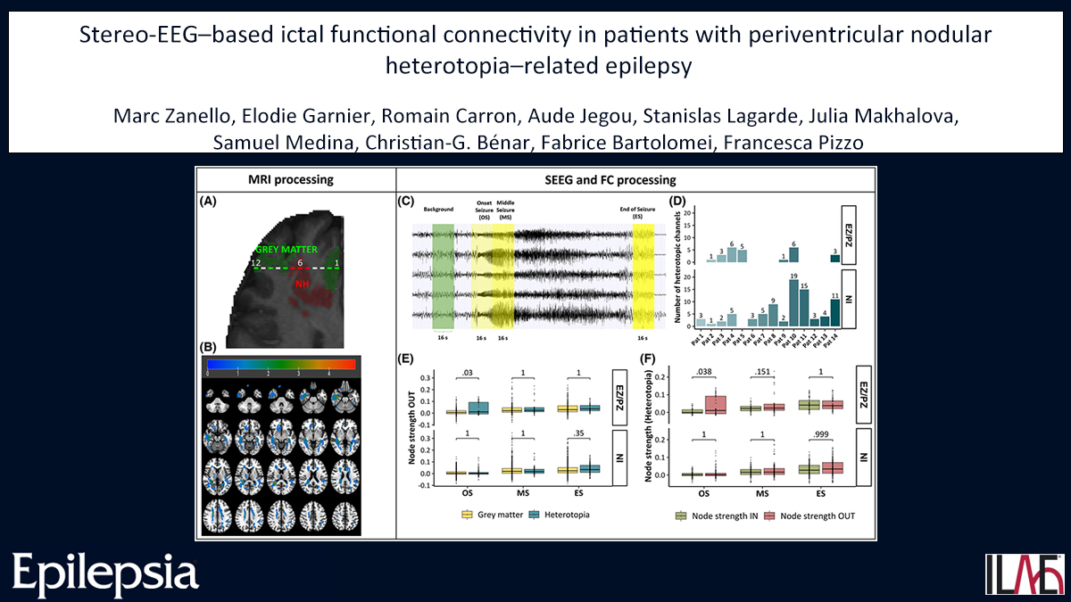 EpilepsiaJourn's tweet photo. Stereo-EEG–based ictal functional connectivity in patients with periventricular nodular heterotopia–related epilepsy
https://t.co/cdBfr60GBe
#epilepsy #ilae #SEEG #h2 #INstrength #OUTstrength #thermocoagulation @IlaeWeb @epilepsiajourn @WileyNeuro https://t.co/MTKOhfCJBR
