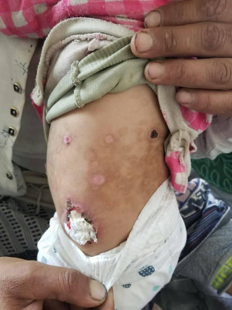 hemo_shk's tweet image. A 3-year-old boy c/o multiple pruritic tense blisters for the previous 6 weeks.The skin lesions were present for several days and then they ruptured spontaneously.
no family hx of skin disease and no hx of URTI or drug intake prior to the onset of blistering
What’s Dx?
#MEDHM