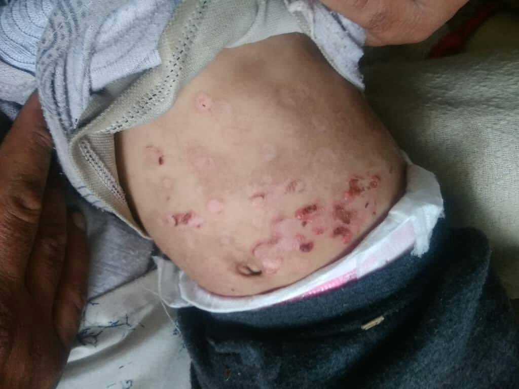 hemo_shk's tweet image. A 3-year-old boy c/o multiple pruritic tense blisters for the previous 6 weeks.The skin lesions were present for several days and then they ruptured spontaneously.
no family hx of skin disease and no hx of URTI or drug intake prior to the onset of blistering
What’s Dx?
#MEDHM