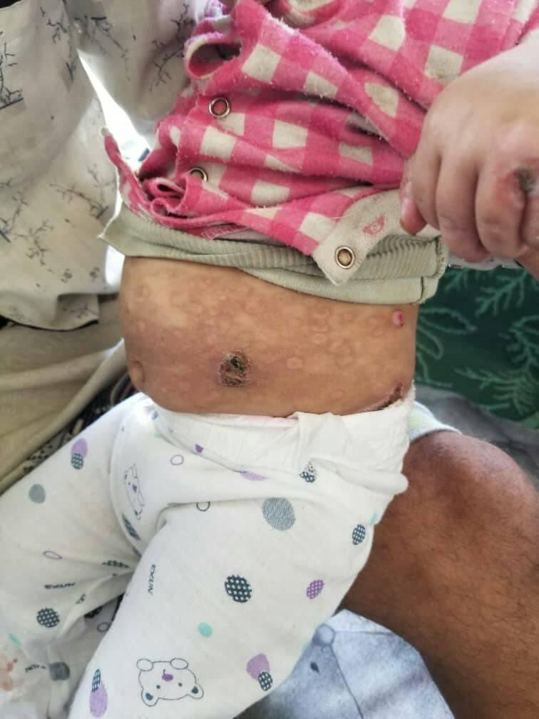 hemo_shk's tweet image. A 3-year-old boy c/o multiple pruritic tense blisters for the previous 6 weeks.The skin lesions were present for several days and then they ruptured spontaneously.
no family hx of skin disease and no hx of URTI or drug intake prior to the onset of blistering
What’s Dx?
#MEDHM