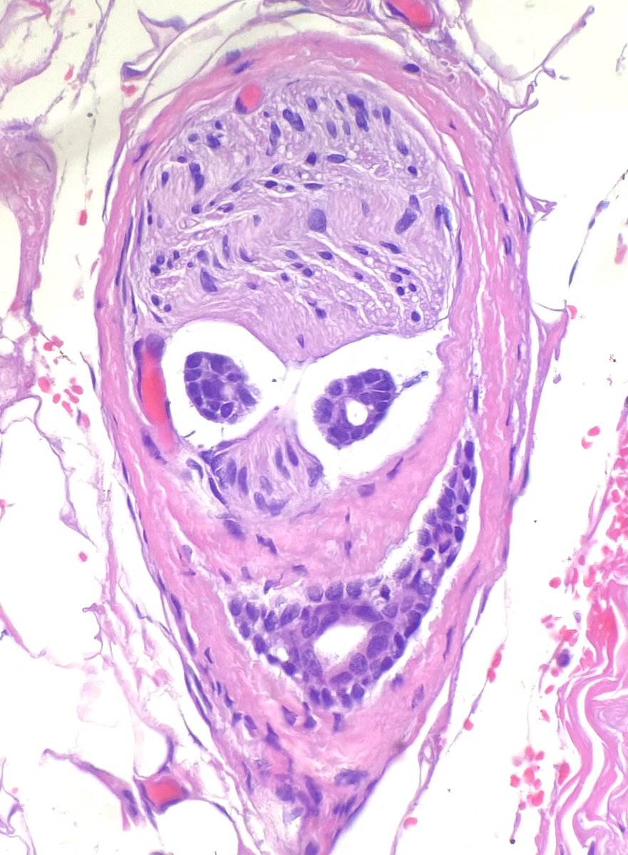 ihartpathology's tweet photo. Little 👽 (aka cutest example of perineural invasion that @LewisPath shared with me!) 🛸🛸 #PathTwitter https://t.co/QAjYgG9jMQ