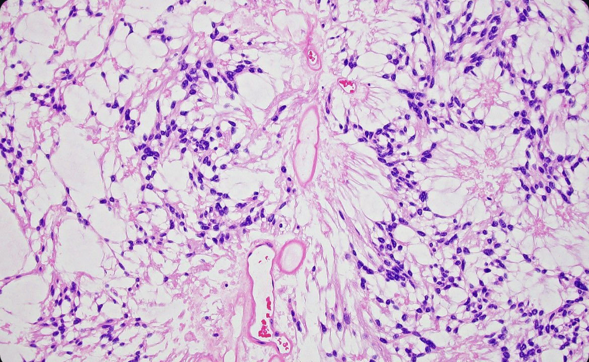 <a href="/kriyer68/">Kalyani Bambal</a> Another variety of ependymal neoplasm is the myxopapillary ependymoma. Note the papillary architecture and myxoid background. Mucoid balls often seen best on smear prep. These tumors are found at the caudal spinal cord (conus medullaris/filum terminale).