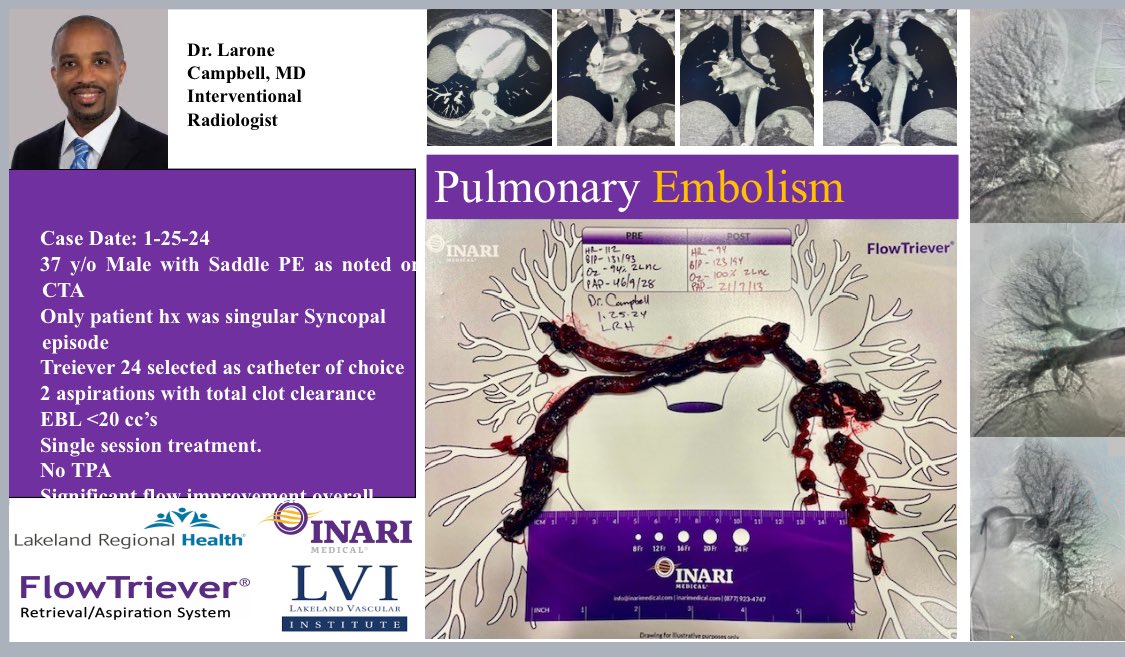 Jodie Reynolds Supervisor-IR LRH (@jojofarley) on Twitter photo Wagwan <a href="/laronecampbell/">M. Larone Campbell</a> ! Only 2 incredible pulls for immediate results! 🫁💪🏼🙏 <a href="/LKLDRegional/">Lakeland Regional Health</a> <a href="/LakelandVascul1/">Lakeland Vascular Institute</a> #pulmonaryembolism #thrombectomy #lrhir Wagwan <a href="/laronecampbell/">M. Larone Campbell</a> ! Only 2 incredible pulls for immediate results! 🫁💪🏼🙏 <a href="/LKLDRegional/">Lakeland Regional Health</a> <a href="/LakelandVascul1/">Lakeland Vascular Institute</a> #pulmonaryembolism #thrombectomy #lrhir