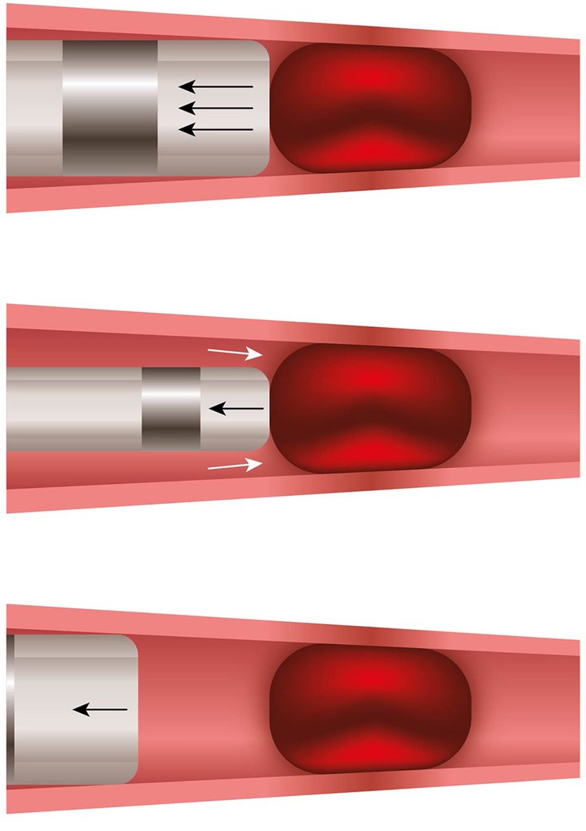 🧠Explore innovative insights on optimizing aspiration catheter size 💉for more effective #EVT for #stroke in our latest issue of the Journal Of Neuroradiology ! #ADAPT sciencedirect.com/science/articl…