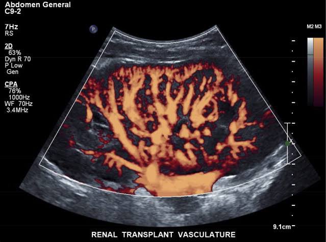 EmergPOCUS's tweet photo. 🤔 ¿Conoces el #Power Angio? 🍊 No Todo es #ColorDoppler 🌈
•A diferencia de otros modos, el doppler power muestra la potencia o intensidad del espectro del flujo, NO su velocidad. Este dato se obtiene de la misma curva espectral. 🔊🔝
•Con una sensibilidad de 3 a 5 veces superior al doppler color, cuanto mayor sea el número de glóbulos rojos en movimiento, mayor será la información recogida. 🩸➕🍊
•#Ventajas: Este modo no presenta aliasing y es independiente del ángulo de incidencia, lo que lo hace especialmente útil en ciertas situaciones clínicas. ✅📏
•A pesar de sus ventajas, el doppler power no proporciona información sobre la velocidad o el sentido del flujo. ❌💨
•Algunos equipos actuales combinan el color angio con la detección del sentido del flujo, mostrando ambos datos simultáneamente. 🆕🔄
#Aplicaciones Clínicas: 🏥
•Permeabilidad del Vaso:✔️🛤️
•Vascularización de Lesiones
•Dirección del Flujo Sanguíneo: Aclaronque aunque el power angio no determina el sentido del flujo por sí mismo, los equipos avanzados pueden combinar técnicas para obtener esta información. 🔄💡
•Detección de Estenosis: Identificar áreas de estrechamiento en los vasos que puedan afectar el flujo sanguíneo. 📉🩺