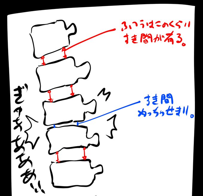 昨日から腰の激痛に襲われ今日は這いつくばるように整形外科へ……

レントゲンの結果背骨が図のようになってしまっていました。
しばらくリハビリ及び通院が必要との事です。
皆さんも腰に異常があれば早めの受診をおすすめします! 