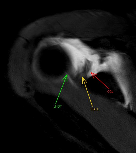 themskarchive's tweet photo. 13/2/2024. 🔴The "ligamentum coracoglenoidale" assessed in #shoulder #arthrogram. Interesting reading in:  https://t.co/FBCkNUxS67 https://t.co/y5BulLETjc