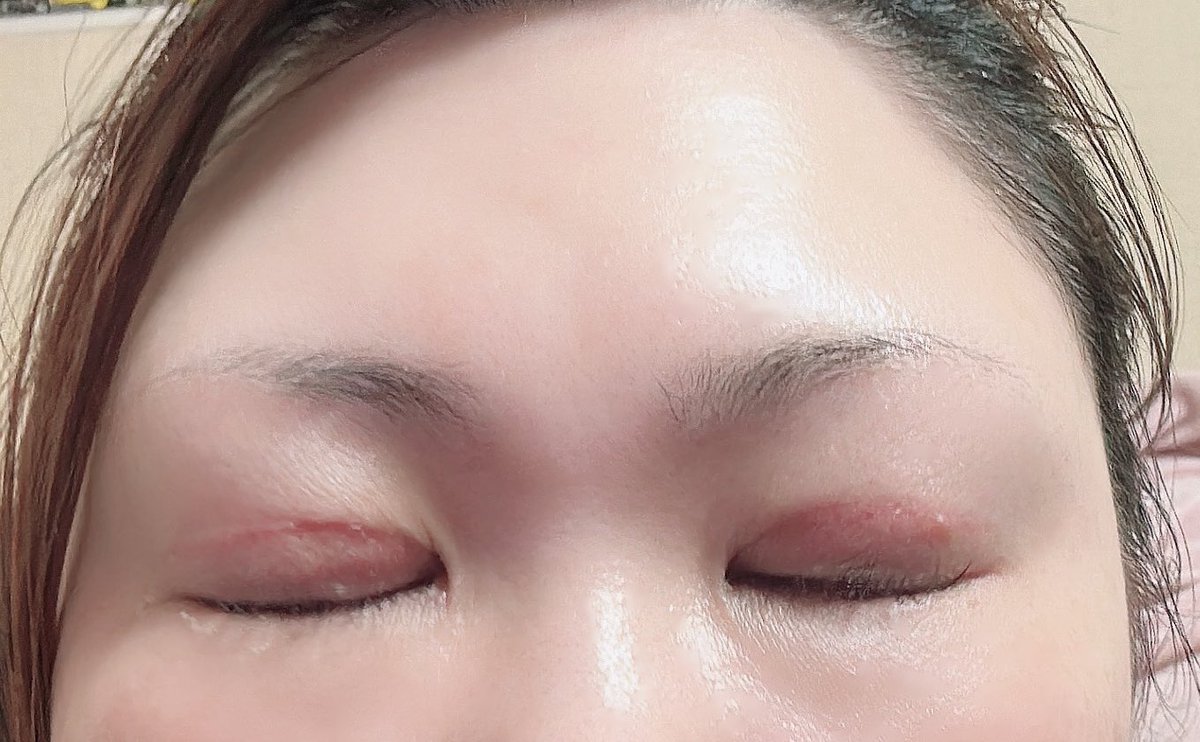 eru0728's tweet photo. 二重切開から３４日目！変わらなかったので、お久しぶりです(*.ˬ.)"目ヤニなどすごいですがすみません💦でもだいぶマシになってきました！明日検診行ってきます(*`･ω･)ゞ
#整形垢 #二重全切開 #整形 #整形垢さんと繋がりたい #美容垢 #美容垢さんと繋がりたい https://t.co/KC3roMzwz2