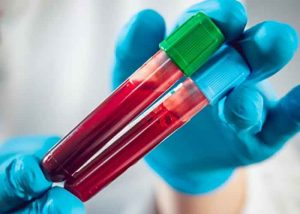 yespunjab's tweet photo. A simple blood test to predict risk of heart attack within six months
#Blood #BloodTest #heartattack #CardiacAttack #HeartAttackPrediction #Health #HearthEALTH #YesPunjab
https://t.co/CKHCDrUuWi https://t.co/oCTmYb8IBV