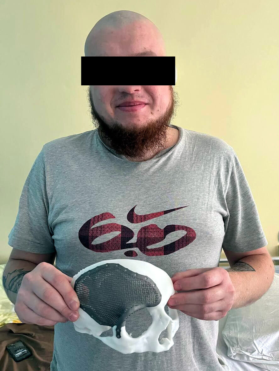 UkraineBerlin's tweet image. Dieser junge Mann hat die Freiheit der Menschen in der 🇺🇦 #Ukraine verteidigt und wurde dabei schwer verletzt. Mit einem Implantat aus dem #3DDrucker konnten die Ärzte ihm helfen. 4 weitere Patienten haben wir aktuell mit unserem #Hilfsprojekt unterstützt:
ukraine-hilfe-berlin.de/knochenimplant…