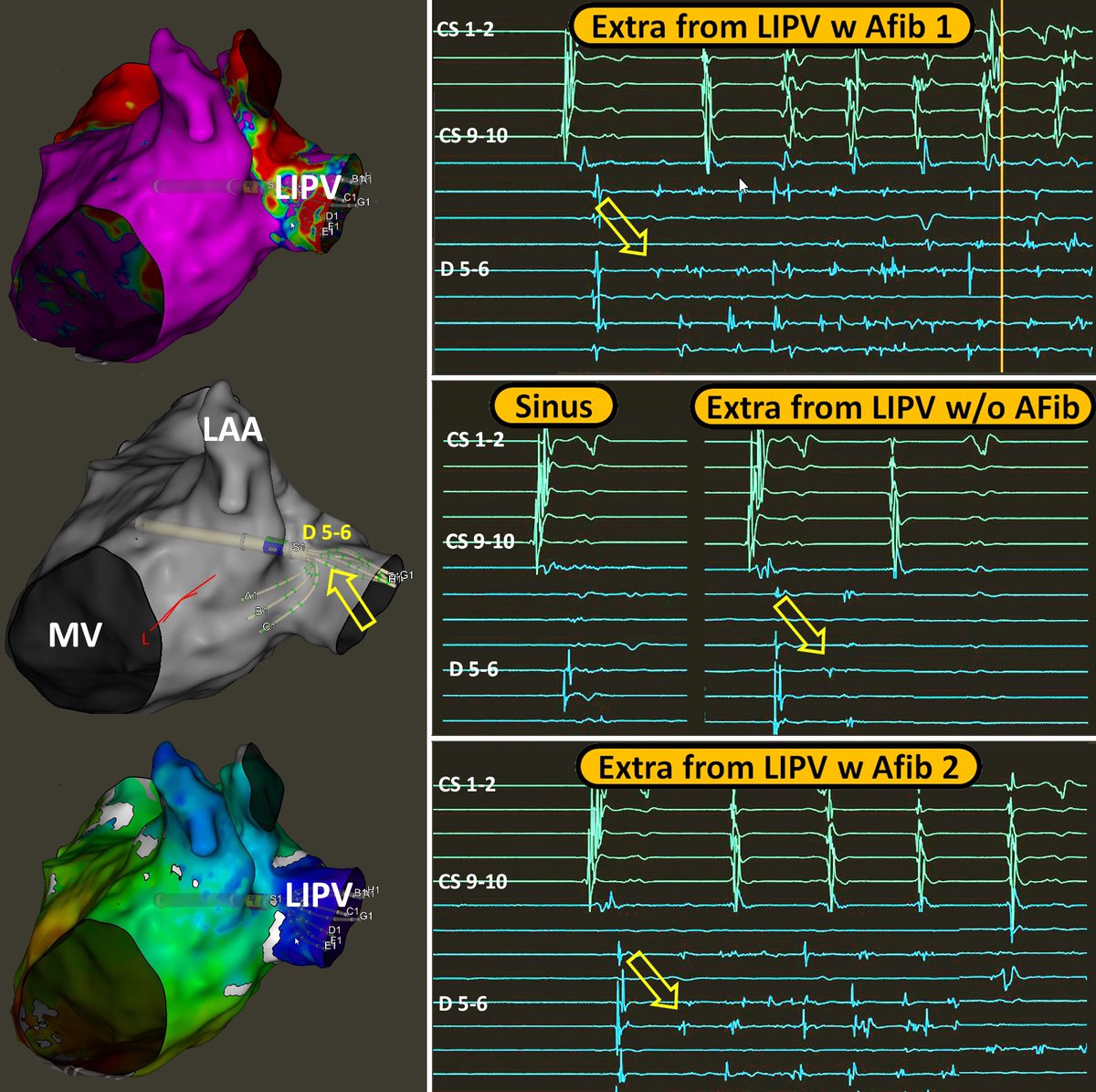 ✨ It’s always nice to witness some #PV #Firing 🔥inducing brief runs of Paroxysmal #AFib ✨ Reconnected #LIPV causing atrial #extras and #AFib with @GiulioConte9
