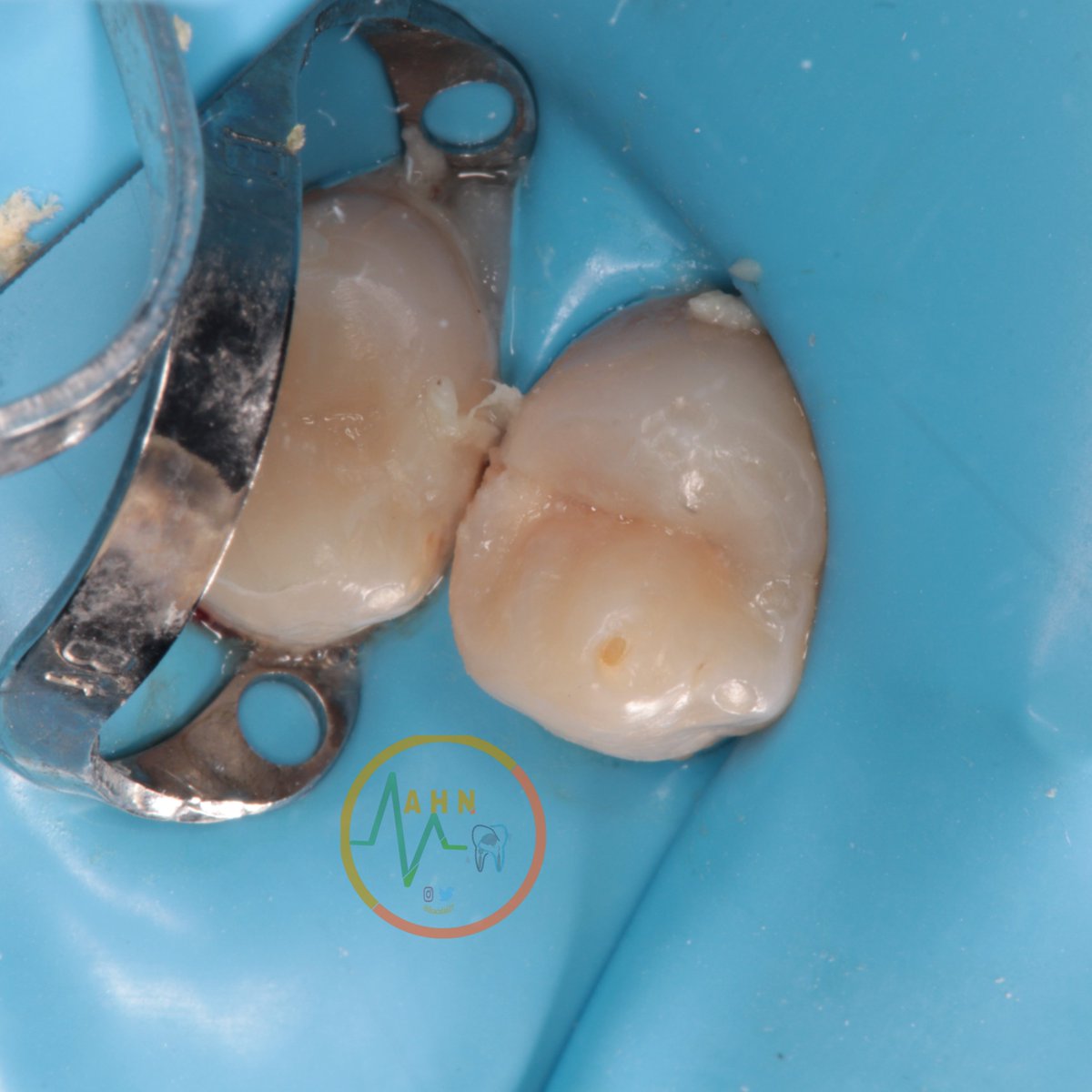 dentist_amar617's tweet image. تم الحفاظ على عصب السن بإزالة التسوس وتغطية الجزء المكشوف السليم من عصب السن تحت العازل المطاطي
Direct pulp caping of 14 under rebber dam
With #DME 
#مجمع_تباهي_الطبي 
#saveatooth 
Scrol down to see the final result