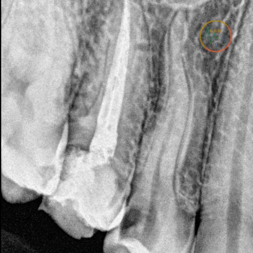 dentist_amar617's tweet image. تم الحفاظ على عصب السن بإزالة التسوس وتغطية الجزء المكشوف السليم من عصب السن تحت العازل المطاطي
Direct pulp caping of 14 under rebber dam
With #DME 
#مجمع_تباهي_الطبي 
#saveatooth 
Scrol down to see the final result