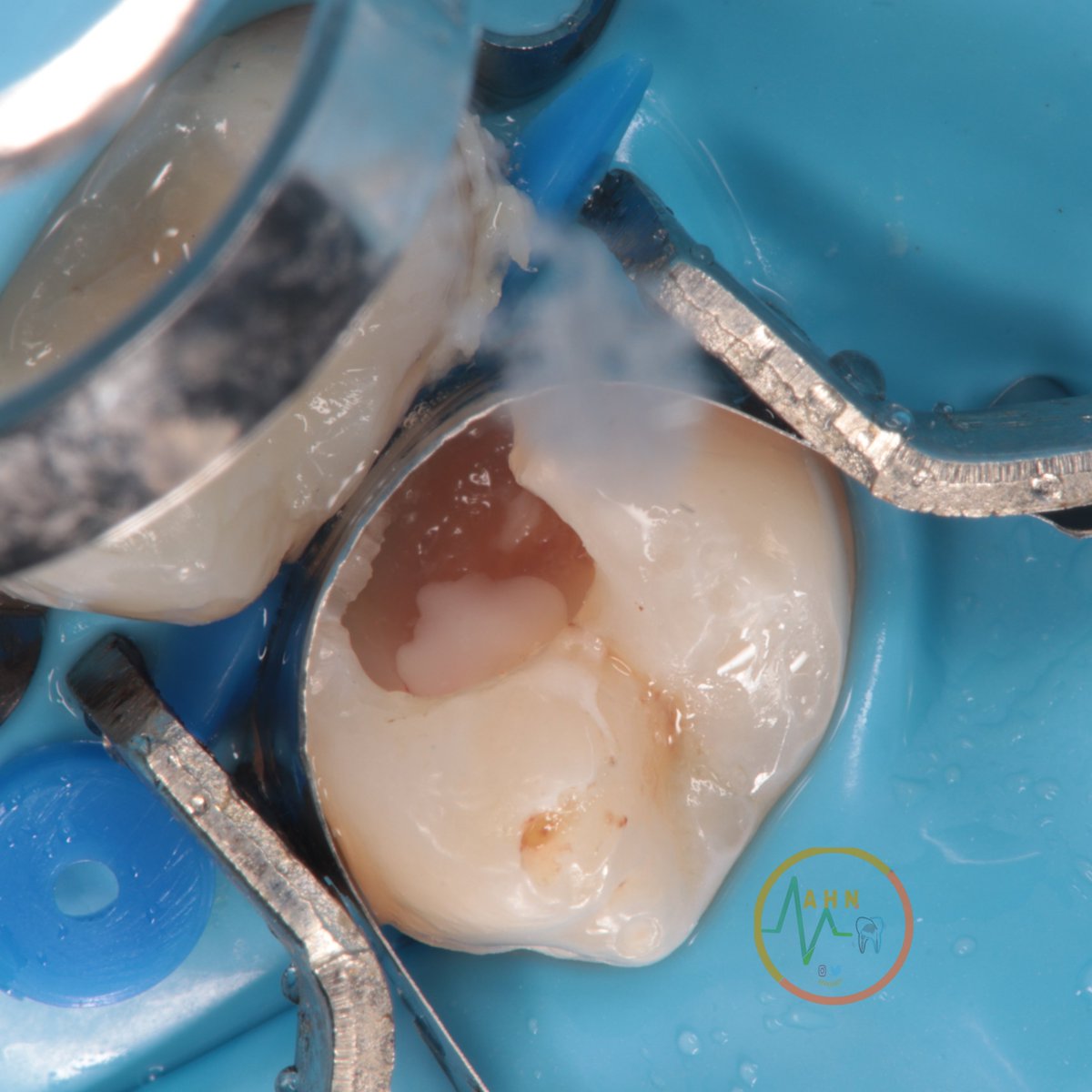 dentist_amar617's tweet image. تم الحفاظ على عصب السن بإزالة التسوس وتغطية الجزء المكشوف السليم من عصب السن تحت العازل المطاطي
Direct pulp caping of 14 under rebber dam
With #DME 
#مجمع_تباهي_الطبي 
#saveatooth 
Scrol down to see the final result