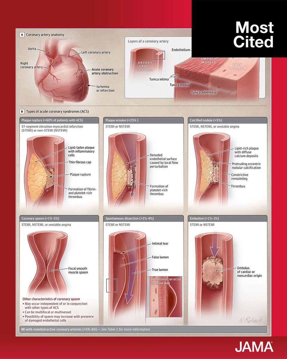 Each year, an estimated more than 7 million people are diagnosed with acute coronary syndromes worldwide.

This review discusses evidence regarding epidemiology, pathophysiology, clinical presentation, diagnosis, management, &amp; prognosis of ACS.

ja.ma/3HWSt0p