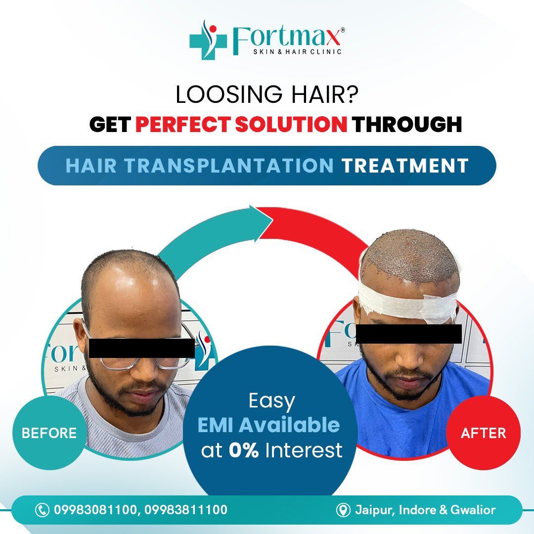 Rediscover confidence with Fortmax Skin & Hair Clinic! ✨ Our pain-free, scarless hair transplant guarantees natural, lush locks. 
#fortmax #hairtransplant #hairsolution #newhair #hairrestoration #scalpcare #hairgrowth #newlook #hairrenewal #hairclinic #hairtreatment #transplant