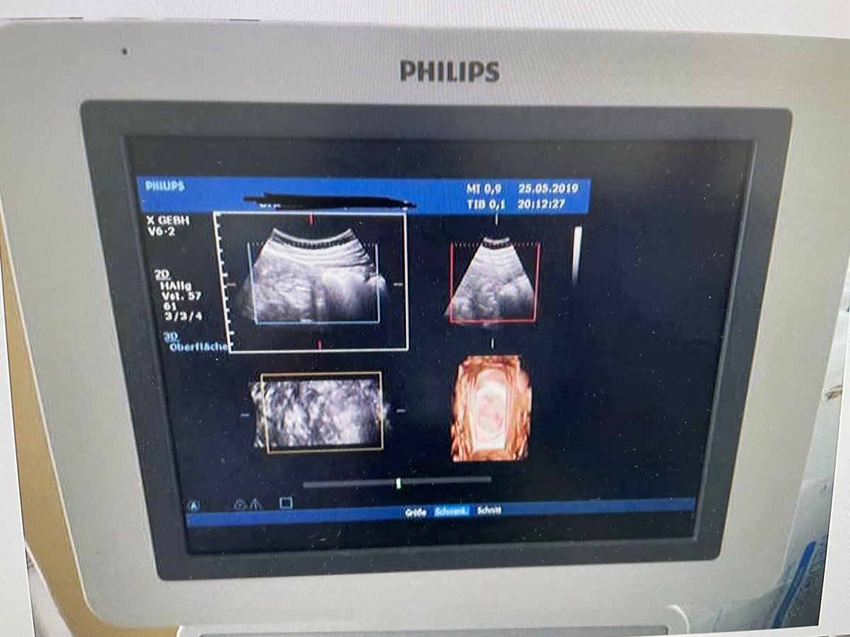 DannCollins_Nig's tweet image. Sharper insights, better care: Raising the standard with the Philips HD15 ultrasound machine.

Send us a DM today. We are your plug for a quality Ultrasound machine. 

#PhilipsHD15 
#ChangingTheGame 
#AdvancedUltrasound 
#UltrasoundExcellence 
#CuttingEdgeTechnology