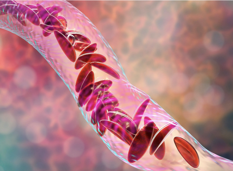 The Biden-Harris Administration said that its new Cell and Gene Therapy Access Model will lower the cost for gene therapy for the treatment of sickle cell disease. Read more here. bit.ly/42xQUQ5