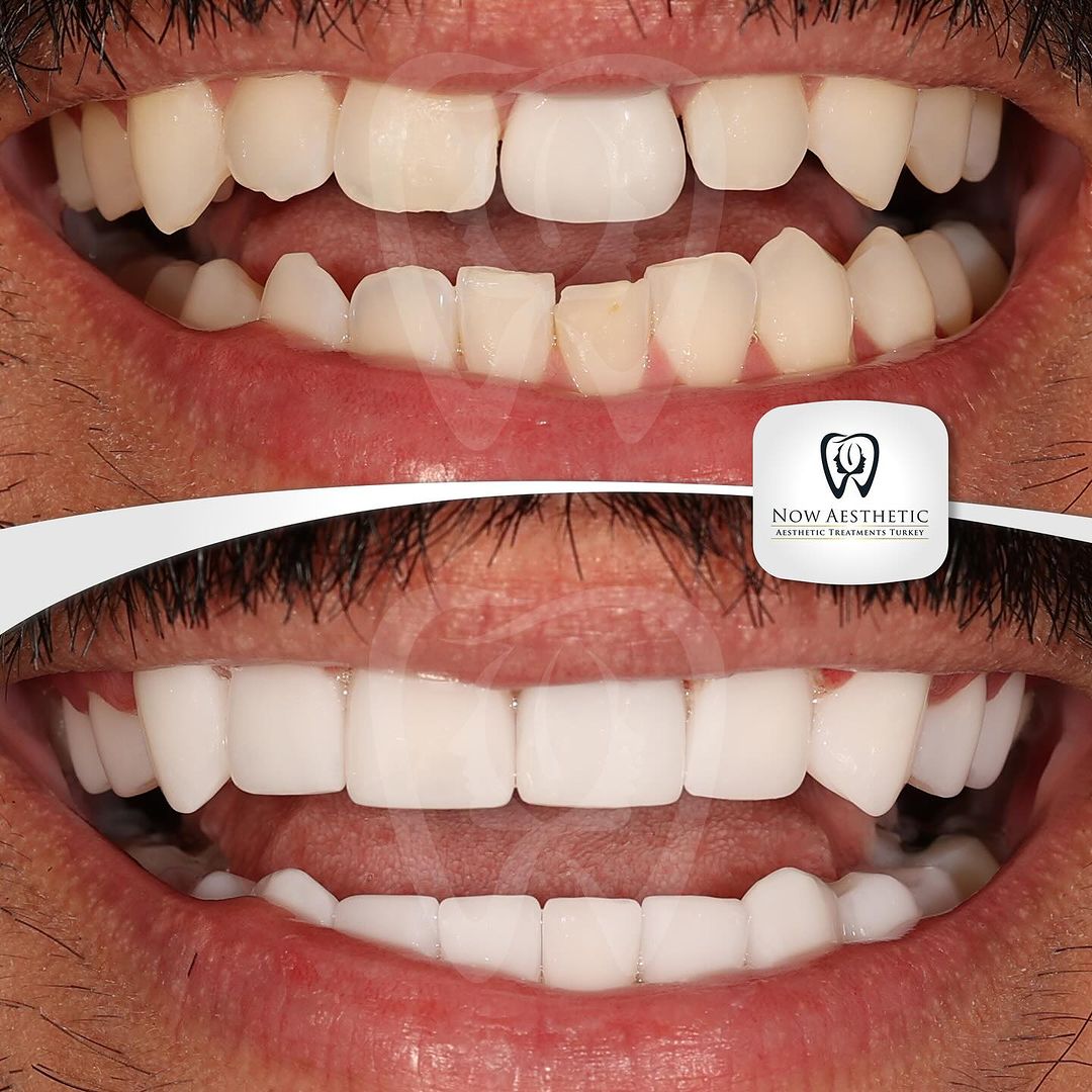 Now Aesthetic | Smile design at the most successful clinic in Turkey!

#veneers #dentalveeners #porcelainveneers #dentalveneers #emaxveneers #veneers_smile #smiledesign #hollywoodsmile