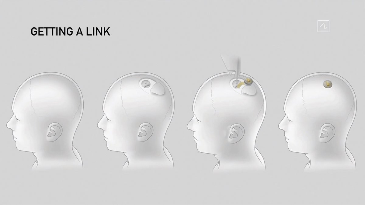 akaryakit's tweet photo. 🌟🧠💻 Đột phá Triển khai: Neuralink của Elon Musk được phép cấy ghép não người! 🌟🧠💻

🚀 Công ty công nghệ sinh học Neuralink, do tỉ phú Elon Musk sở hữu, đã nhận được sự chấp thuận từ Cục Quản lý Thực phẩm và Dược phẩm Mỹ (FDA) cho thử nghiệm cấy ghép não ở người, mở ra cánh cửa cho việc nghiên cứu lâm sàng trên người.

🧬 Neuralink đang phát triển một con chip có khả năng cấy ghép vào hộp sọ để kết nối với não người, theo dõi hoạt động não và có khả năng kích thích các chức năng não.

🔬 Elon Musk hình dung rằng công nghệ cấy ghép não có thể chữa trị nhiều loại bệnh từ béo phì, tự kỷ đến trầm cảm và tâm thần phân liệt, đồng thời cung cấp nhiều ứng dụng khác nhau như duyệt web và phát triển khả năng thần giao cách cảm.

🔮 Mục tiêu cuối cùng của Neuralink không chỉ là trị bệnh mà còn là ngăn chặn sự lấn át của trí tuệ nhân tạo (AI) đối với con người.

💭 Musk hằng tin rằng đồng bộ trí óc với máy móc là quan trọng để đảm bảo con người không bị vượt qua bởi AI, tuy nhiên, mặc dù có đầy triển vọng, các chuyên gia vẫn đề xuất biểu cảnh của Musk.

🌟🌐💡 Neuralink tiến bộ trong việc ứng dụng công nghệ để cải thiện sức khỏe và trí tuệ con người, mở ra một tương lai với nhiều triển vọng và tiềm năng! 🌟🌐💡