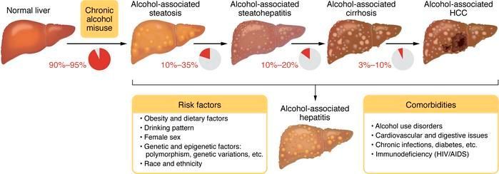 jclinicalinvest's tweet photo. #Review:
Alcohol-associated liver disease: https://t.co/3f0lU5UzER 

@NIAAAnews https://t.co/oj6ZInkti9